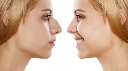 rhinoplastie